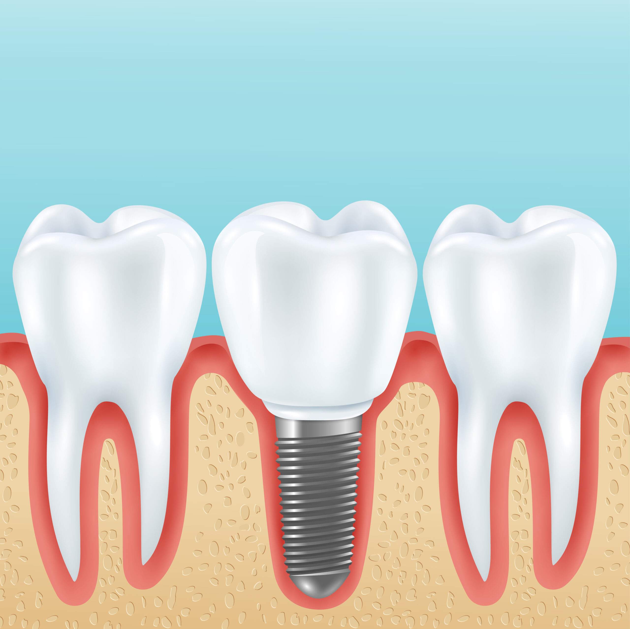 Implantes dentales en Santander